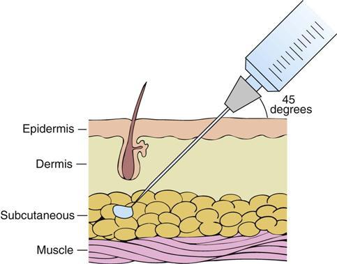 A example of a sub dermal layers and a needle injecting into the Subcutaneus layer